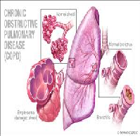 Chronic Obstructive Pulmonary Disease Paper