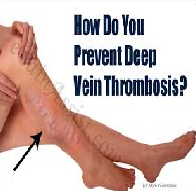 Deep Vein Thrombosis and Preventative Measures