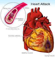 Myocardial Infarction and a History of a Heart Attack