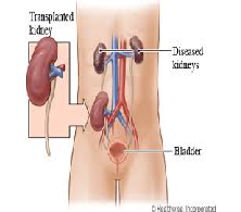 Role of Nursing In Renal Transplant Surgery