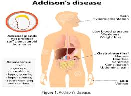 Side effects of Corticosteroid to treat Addisons Disease