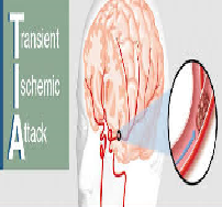 Stroke can occur at any Age