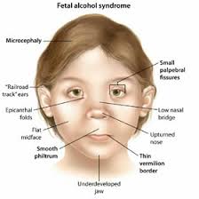 Foetal Alcohol Spectrum Disorders