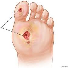 Prevention of foot ulcers 