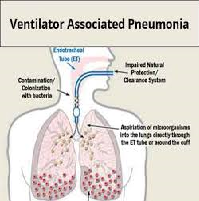 Ventilator Associated Pneumonia Research Paper
