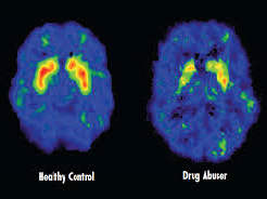Drugs Effect on Central Nervous System of the Brain