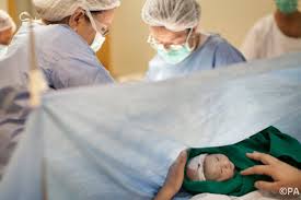 The UK has one of the highest cesarean rates in the world