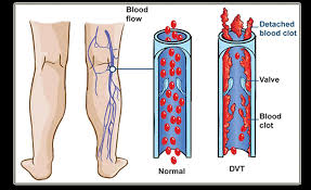 Deep vein thrombosis