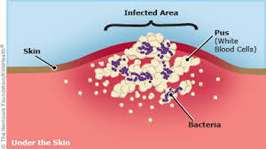 Staph infections Case Study
